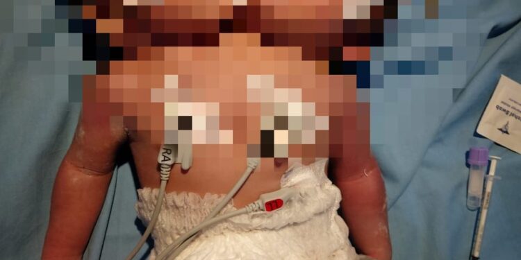 Terlahir Kembar Siam, Bayi Dua Kepala Satu Tubuh di Pariaman Butuh Perawatan Khusus