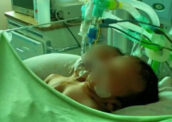 Dava dan Davin, bayi kembar siam saat jalani perawatan intensif di RSUP Dr. M Djamil Padang (ist)