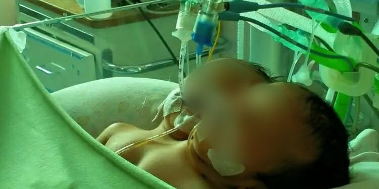 Dava dan Davin, bayi kembar siam saat jalani perawatan intensif di RSUP Dr. M Djamil Padang (ist)