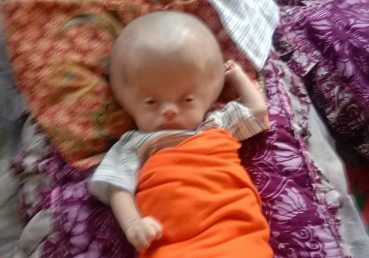 Ardio Omar Asmara, bayi berusia 23 hari asal Pesisir Selatan yang mengalami hidrosefalus.