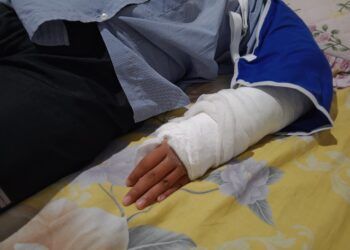 : Tangan kiri siswi SD di Lubuk Sikaping, Pasaman, yang mengalami patah pergelangan tangan setelah terjatuh saat kegiatan olahraga di sekolah.