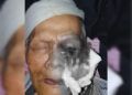 Gusnali, Lansia di Solok Derita Tumor Ganas, Terkendala Biaya Pengobatan Rp100 Juta